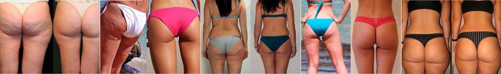 gambe di ragazze prima e dopo il trattamento 2slim anticell