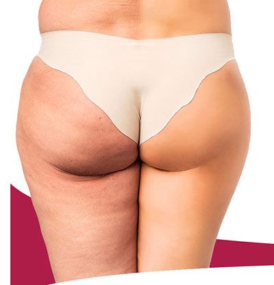 gambe prima e dopo l'uso di una crema anticellulite