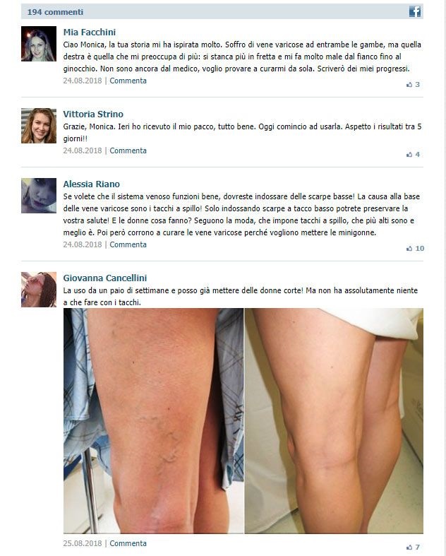 varicoza mai multe vânatai pe picioare