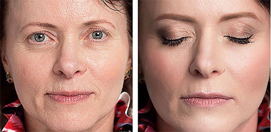 viso prima e dopo trattamento con crema antirughe