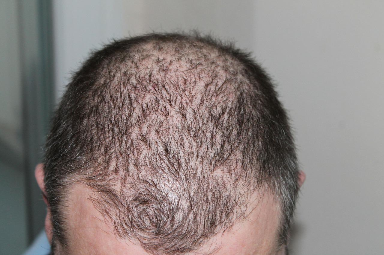 uomo con alopecia