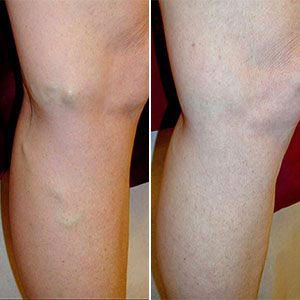 gambe post trattamento con vein stopper