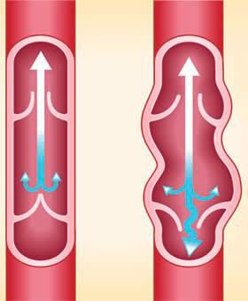 esempio di vene varicose e vene normali in infografica